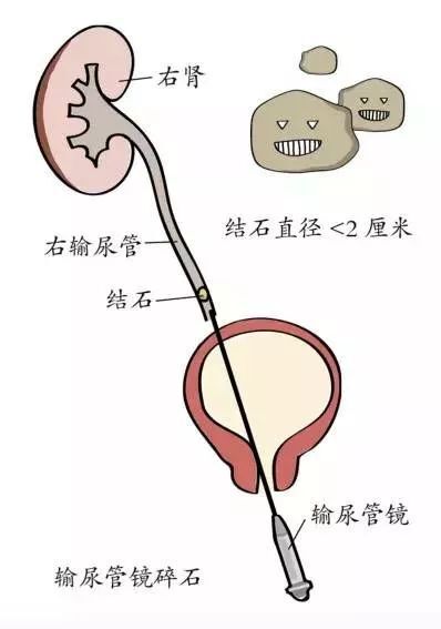 ① 输尿管镜碎石取石术 经尿道插入输尿管镜至膀胱,经膀胱输尿管口