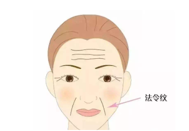 康康爆炸线填充法令纹8根线神仙操作! 爆炸线多久吸收