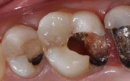 备受牙痛折磨,到底得的是什么牙病?牙医教你区分,教你