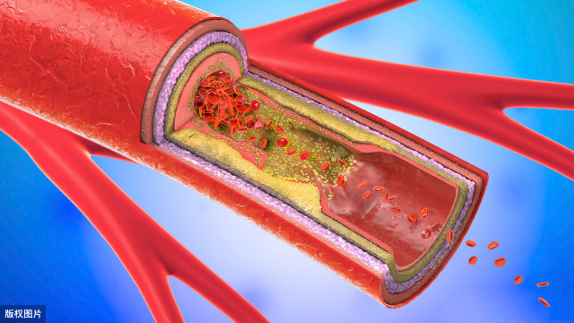 动脉硬化有哪些治疗方法?专家:90%通过治疗,效果显著