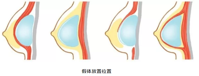 一罩杯需假体大概80-100cc,亚洲人通常能够承受的极限是单侧300cc左右