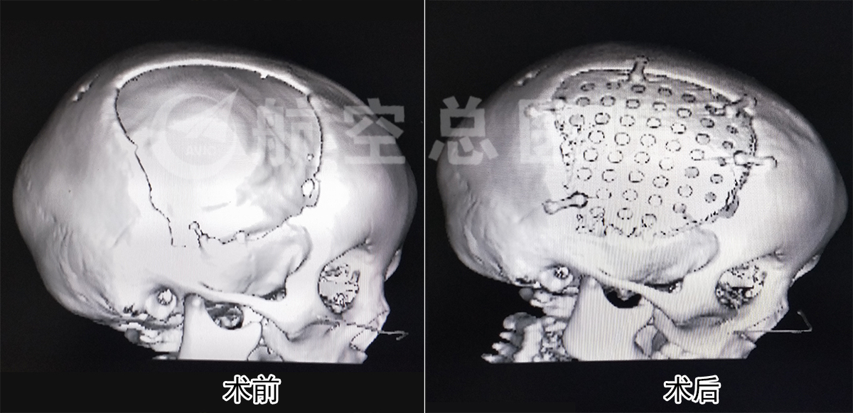 三岁女童摔伤致颅骨缺损,神外专家硬核行修复整形