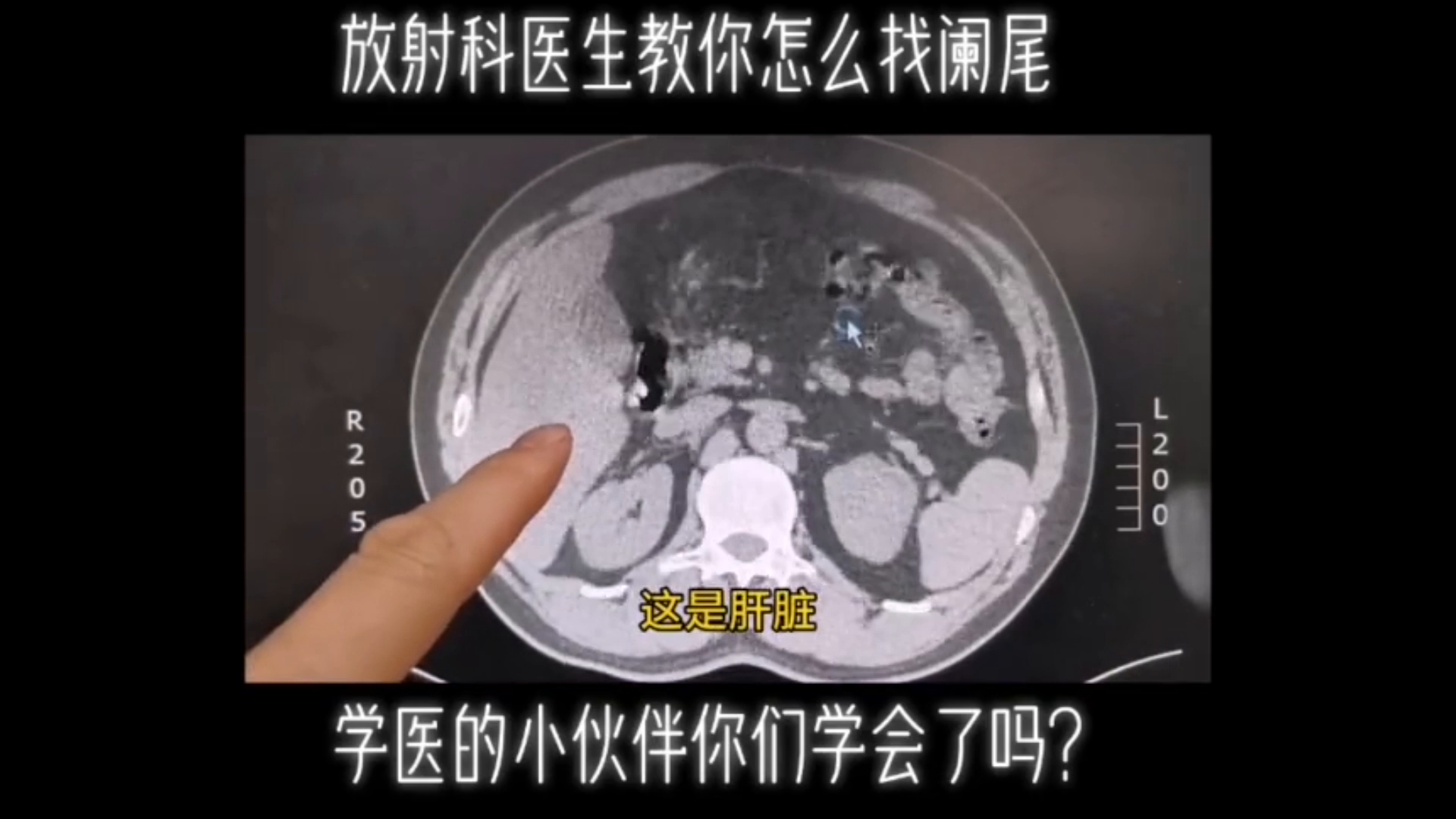 医疗人体组织器官大肠盲肠阑尾局部示意图科普插画图片-千库网
