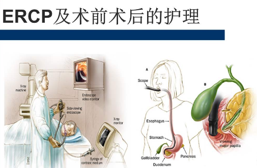 内镜ercp胆总管取石 胆囊切除的优点跟缺点都有些什么?