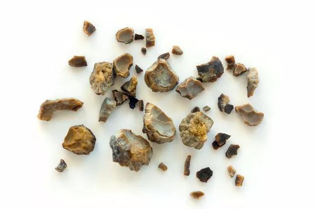 肾结石有一种情况就是出现十多年了,但是没什么症状,这种最可怕