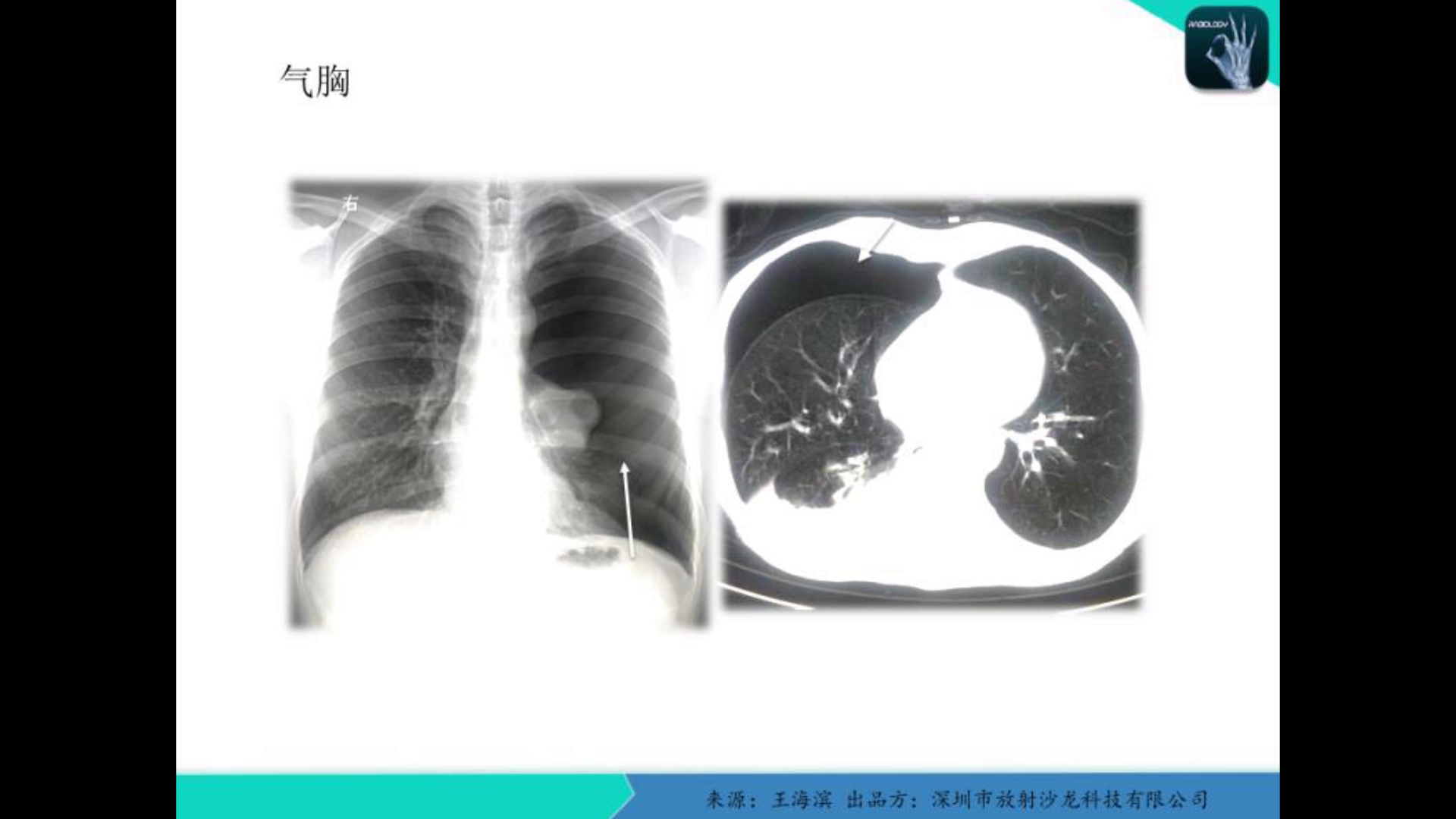 肺的结构-外科学-医学