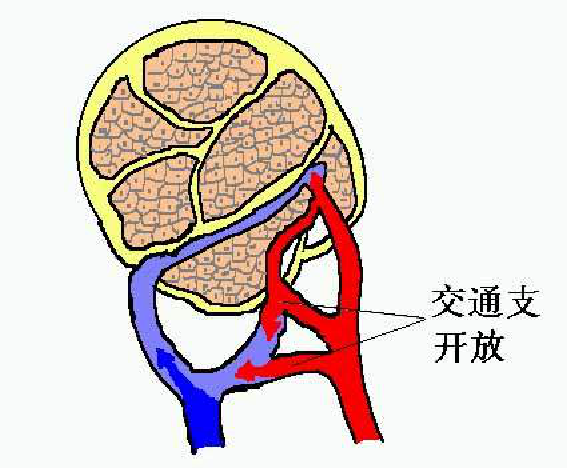 肝硬化时,交通支开放,肝动脉血流入门静脉,从而使门静脉压力更高