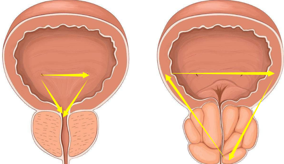 膀胱三角在膀胱底的内面,位于两侧输尿管口与尿道内口之间的三角形