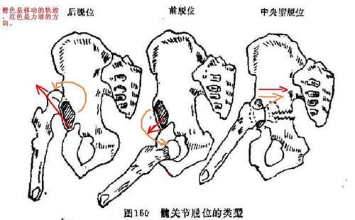髋关节脱位的临床表现__凤凰网