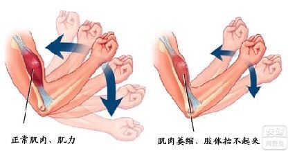 肌肉萎缩常见症状表现