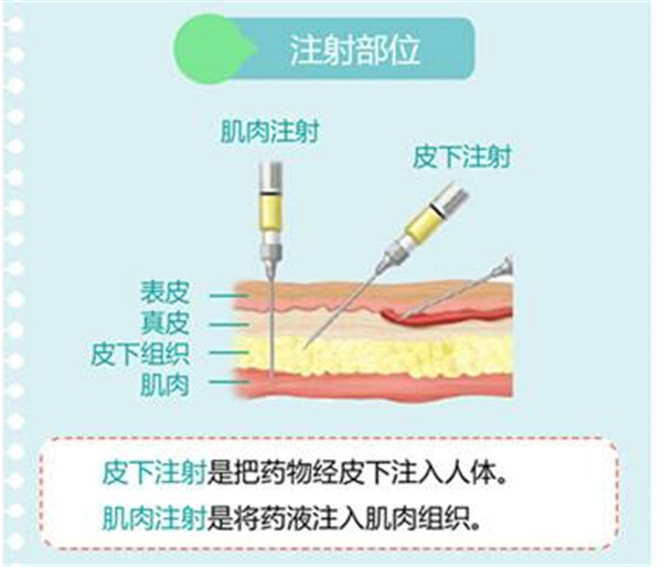 一般皮下注射,常用注射部位为上臂三角肌下缘,腹部,股外侧; 注射部位
