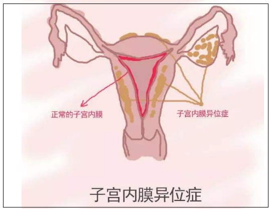 如在卵巢,子宫骶骨韧带,子宫下段后壁浆膜层,子宫直肠陷窝以及乙状