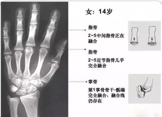骨龄通常拍摄左手手腕部(离主要脏器较远的末端部位),使用的x线是一