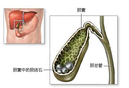 晚期胆管狭窄往往会出现于手术后三个月左右,这个时候