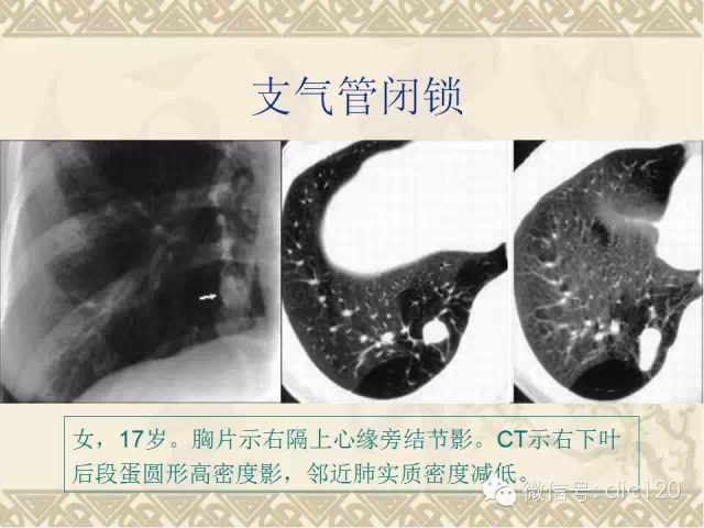 先天性支气管闭锁的影像学诊断__凤凰网