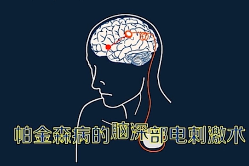 帕金森病的治疗方法