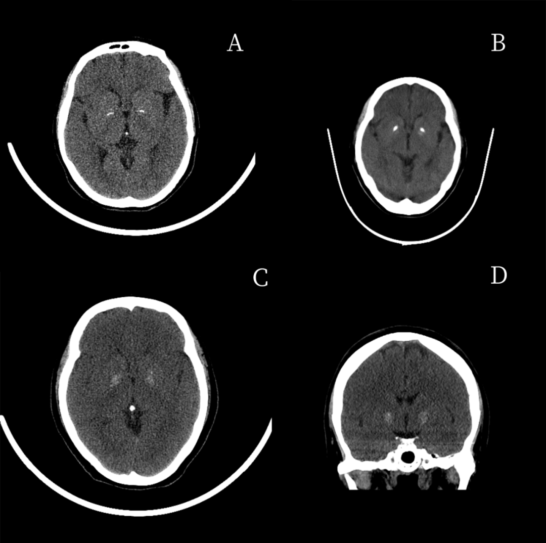 影像表现: 头颅 ct 平扫及冠状位重建示双侧基底节区生理性钙化主要