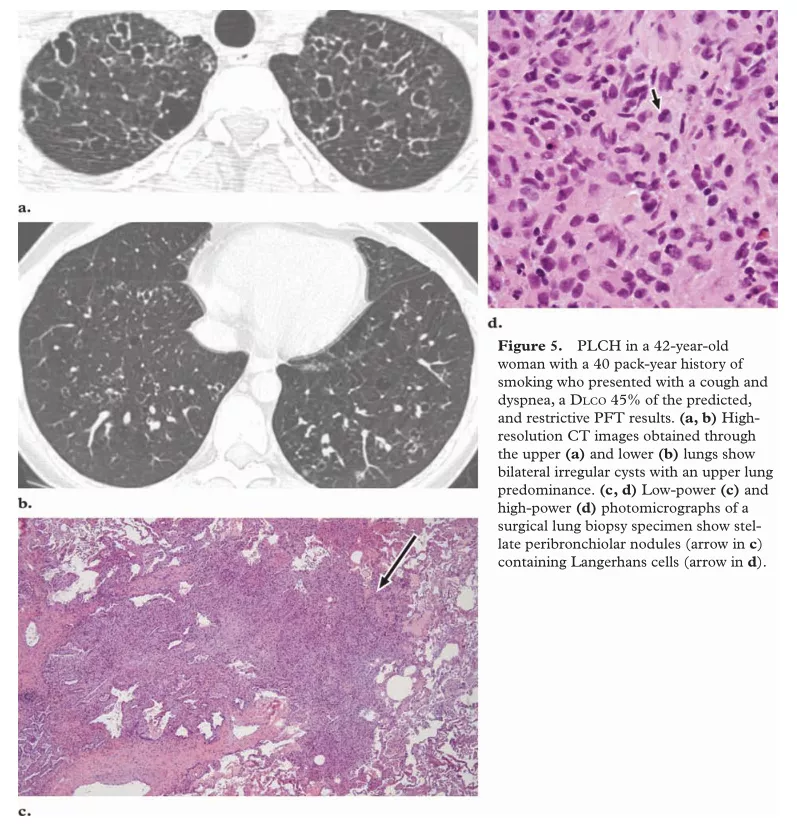 肺间质纤维化合并肺气肿(combined pulmonary fibrosis and emphysema