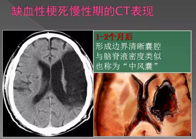 缺血性,出血性,分水岭,腔隙性四大类脑梗的影像解读