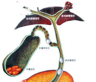很多人对胆管结石不是特别重视,今天我们就来介绍一下它的危害