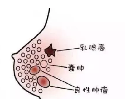 胸部胀痛,警惕癌变,当乳腺出现这些异常时,要提高警惕