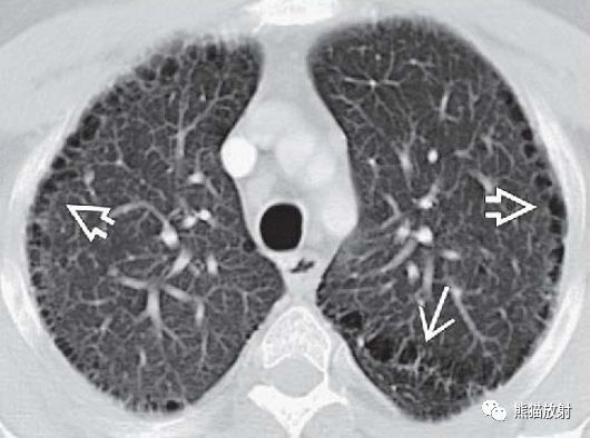 全小叶型间隔旁型肺气肿ct诊断要点