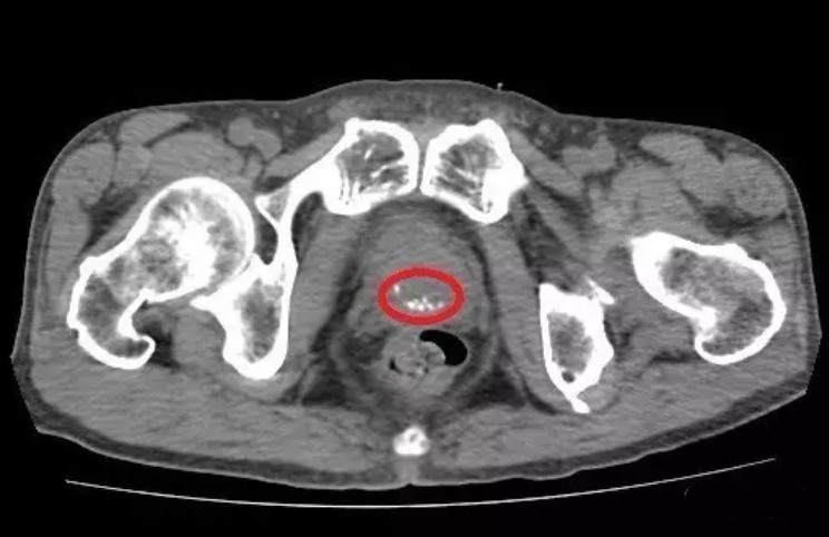 【神麻贡品】b超,ct,核磁共振下,前列腺钙化原来是这样的