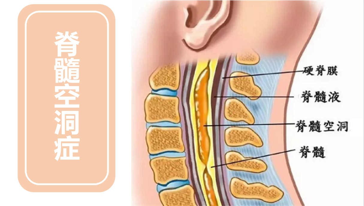 1,起病特征:因脊髓空洞常在一侧的颈膨大的后角基底部,脊髓空洞症的