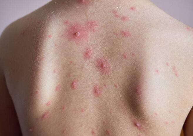 病毒等感染,引起相关的皮肤疾病,如 口腔溃疡,手足癣,毛囊炎,带状疱疹