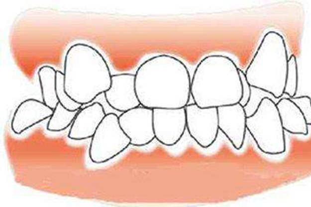 牙齿拥挤造成牙齿不齐如何矫正呢?
