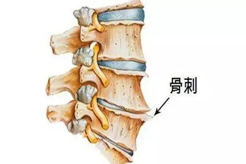 长了骨刺一定要除之而后快吗