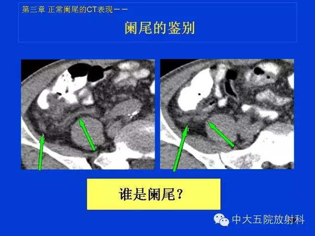 全面讲解 | 正常阑尾和阑尾炎的ct表现