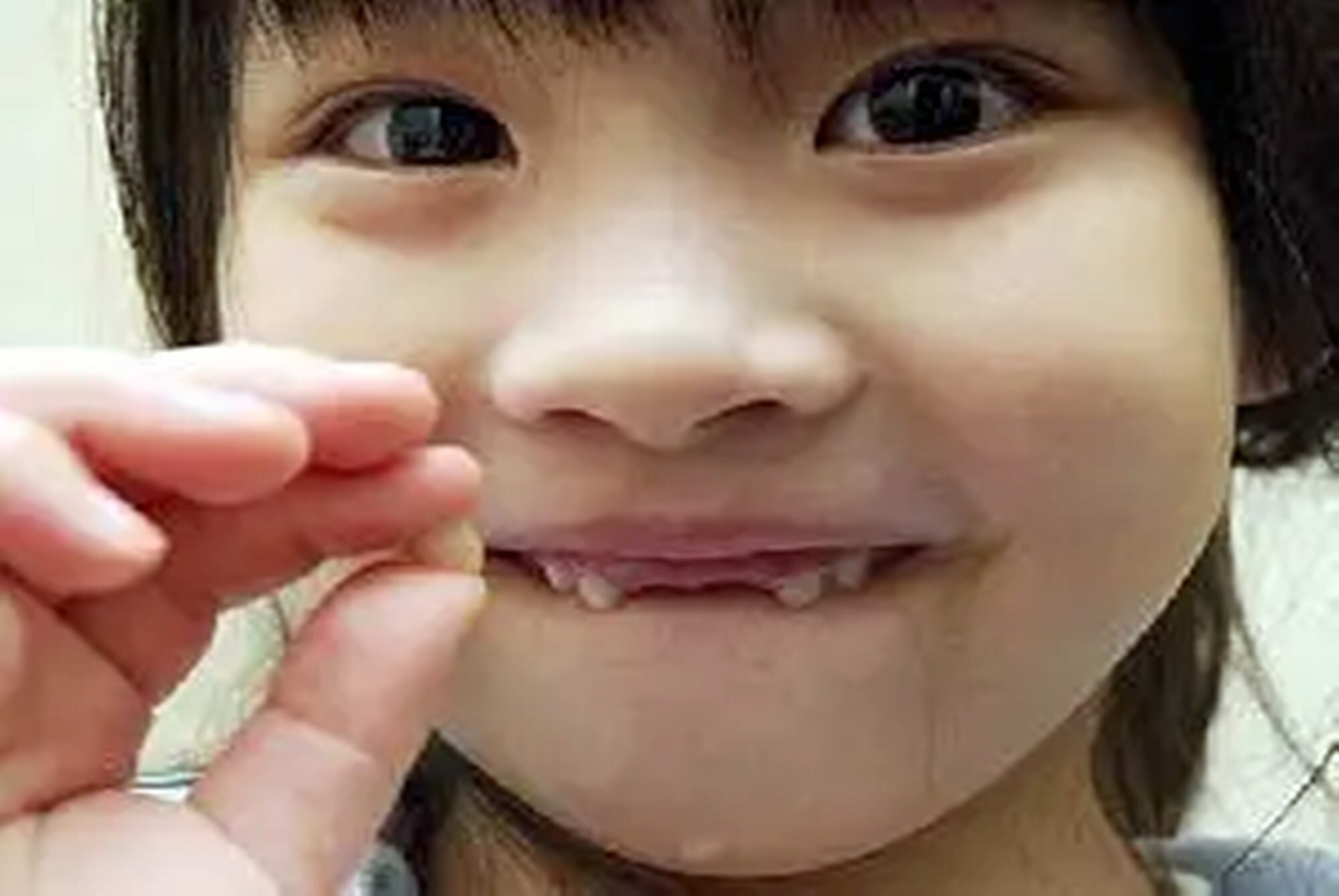 2 乳牙的龋病特点-儿童口腔科图谱-医学