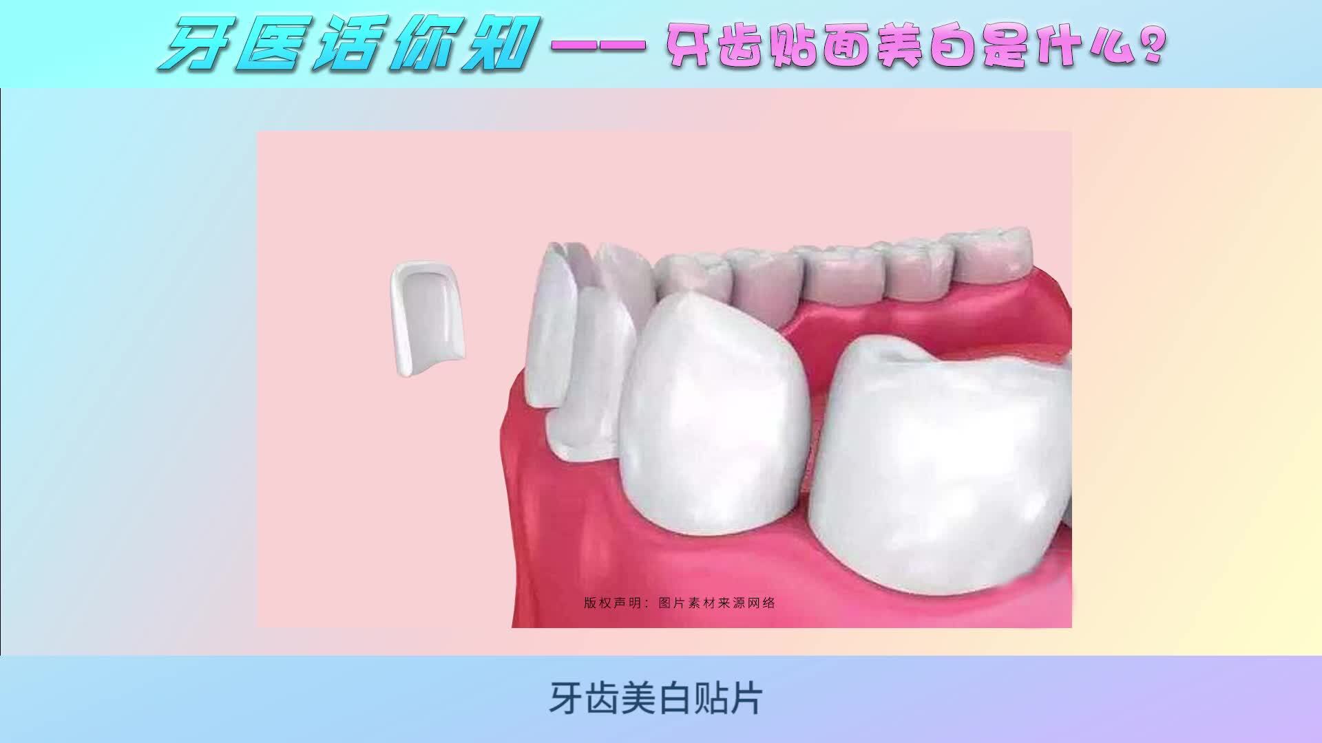什么是牙齿贴面?哪些牙齿症状适合做贴面?