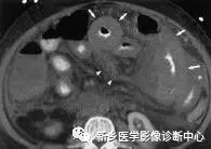 肠梗阻:中腹部多发阶梯状,马蹄状液平.2.空肠不全性梗阻 1.