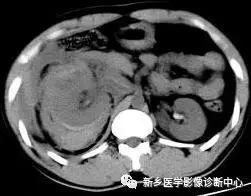 肠梗阻:中腹部多发阶梯状,马蹄状液平.2.空肠不全性梗阻 1.