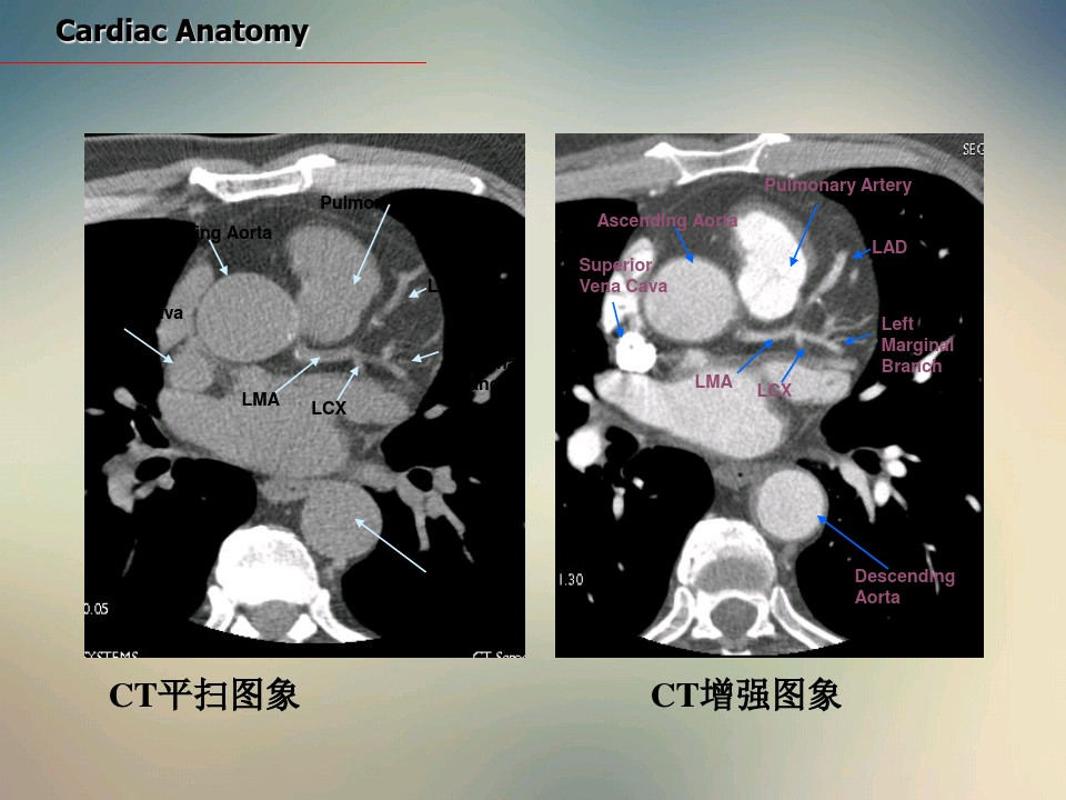 心脏ct断面解剖