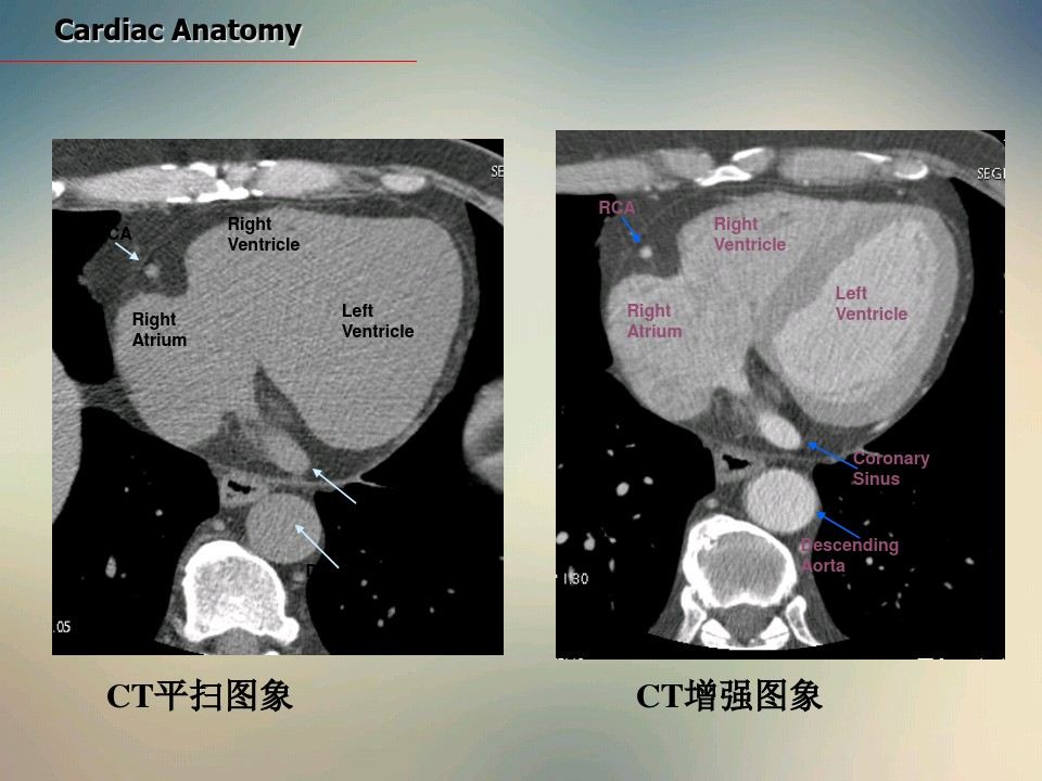 心脏ct断面解剖__凤凰网