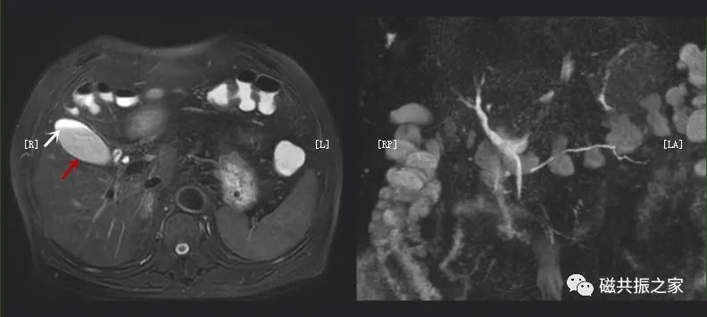 在t2wi上可以看到明显的胆囊结构(红箭头,但在mrcp图像上胆囊并未