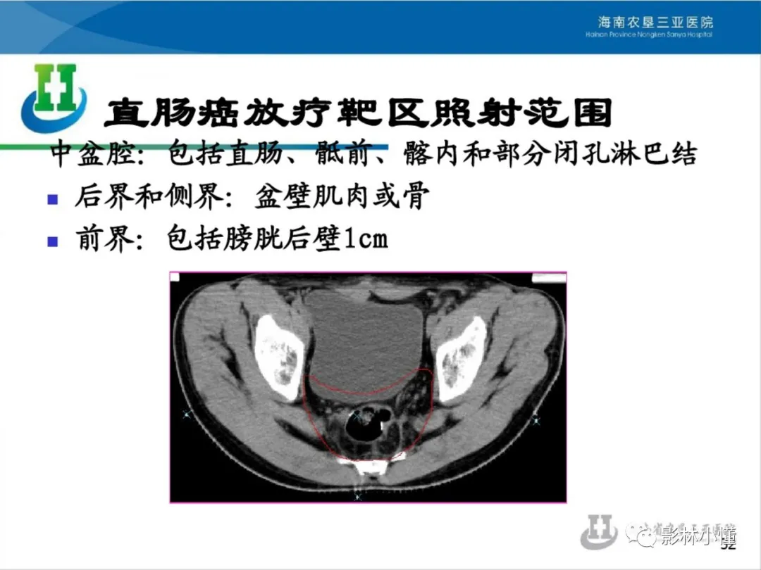 盆腔淋巴结的影像解剖及临床应用