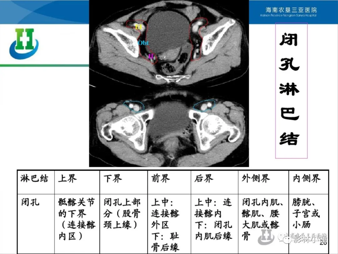 盆腔淋巴结的影像解剖及临床应用