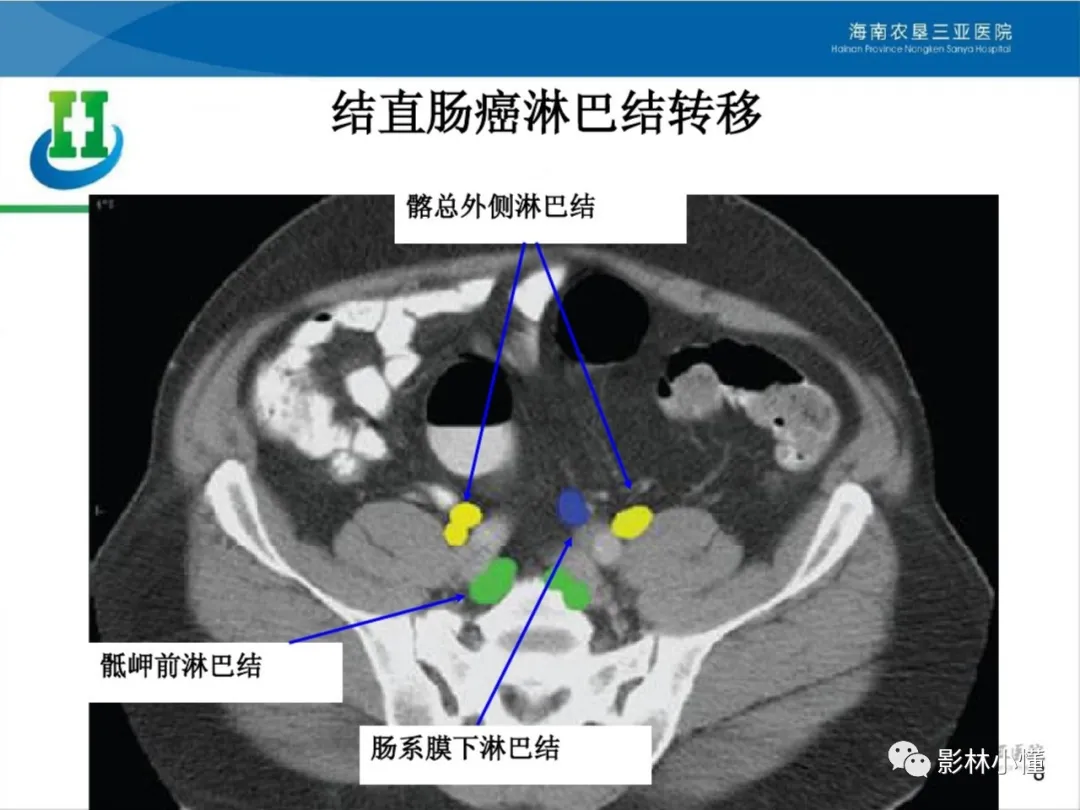 盆腔淋巴结的影像解剖及临床应用