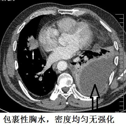 这种"胸水,做胸腔穿刺要出大事!