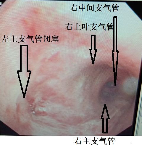 这种"胸水,做胸腔穿刺要出大事!