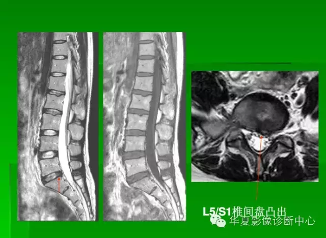 椎间盘的突出,膨出,脱出,髓核游离大家都分清楚了吗?