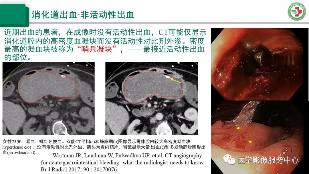 上消化道出血的ct诊断__凤凰网