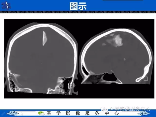 易误诊为出血的大脑镰钙化,你会看吗?