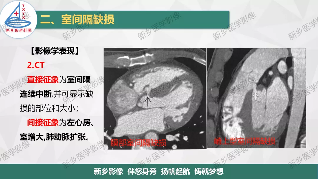 【一图明白】房缺,室缺,动脉导管未闭如何分型?