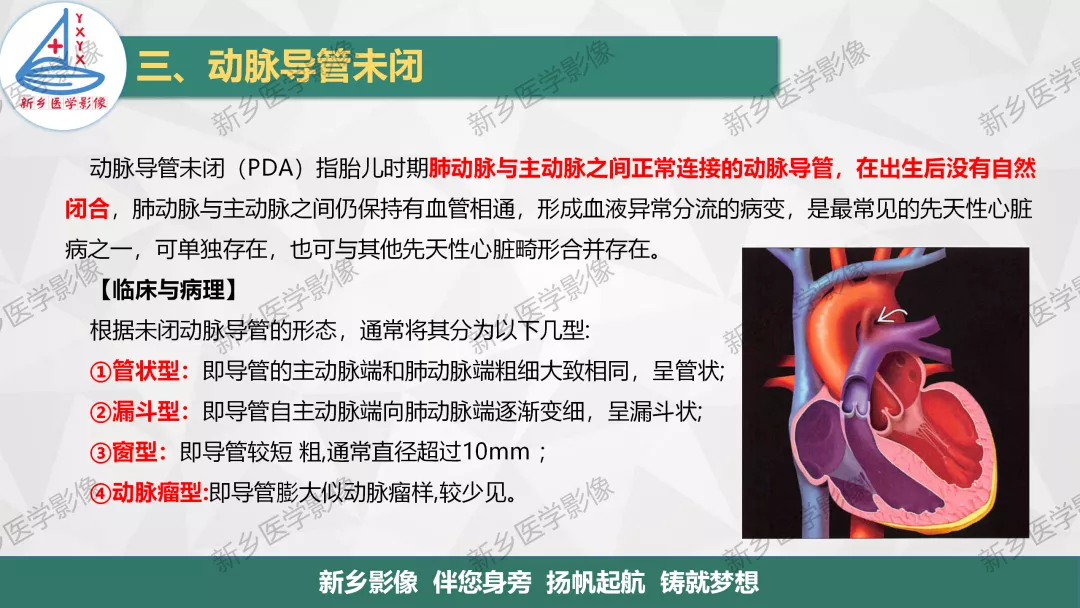 【一图明白】房缺,室缺,动脉导管未闭如何分型?