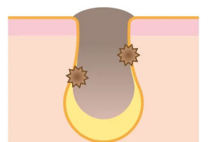 做完果酸换肤出现烂脸怎么办？医美专家建议试试这个方法